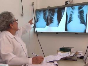 Casos de tuberculose aumentam na Paraíba, informa SES