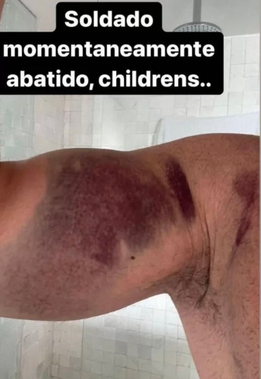 Deputado estadual Caio Roberto exagera na "malhação" e rompe tendão do peitoral; veja as fotos